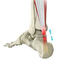 Achilles Tendon Repair