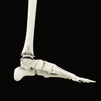 Ankle Joint Replacement