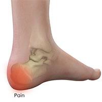 Heel Pain