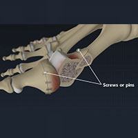 Minimally Invasive Bunion Surgery