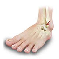 Stress Fractures of the Foot and Ankle