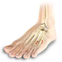 Toe and Forefoot Fractures