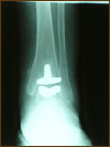 Total Ankle Replacement