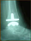 Total Ankle Replacement