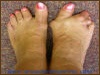 Rheumatoid Foot