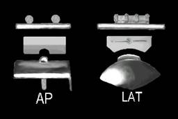 Total Ankle Replacement